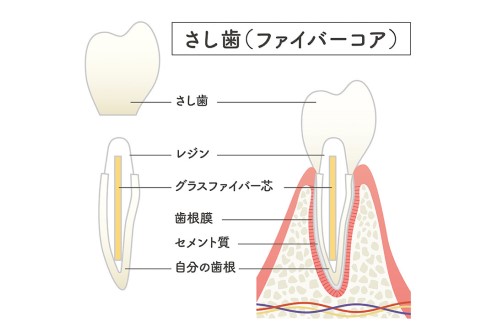 ファイバーコア
