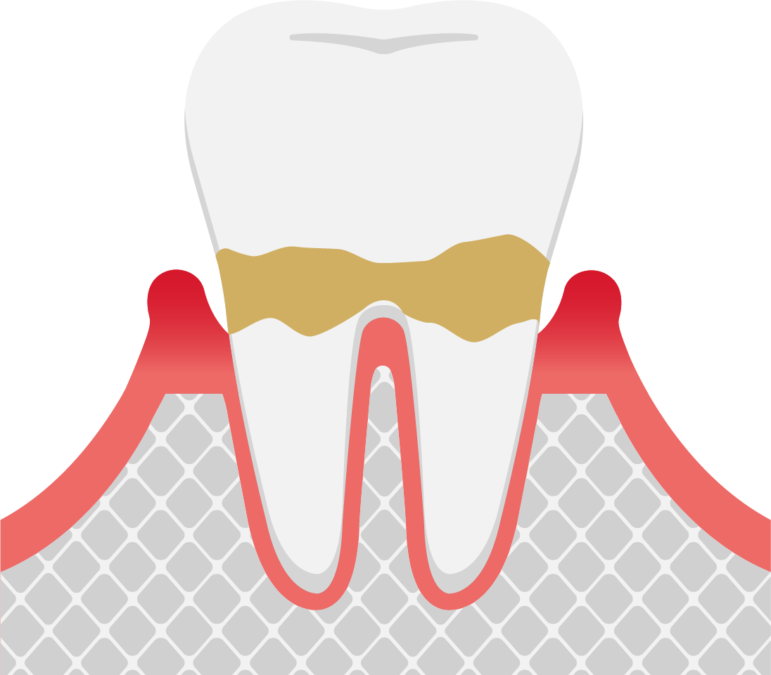 軽度歯周炎