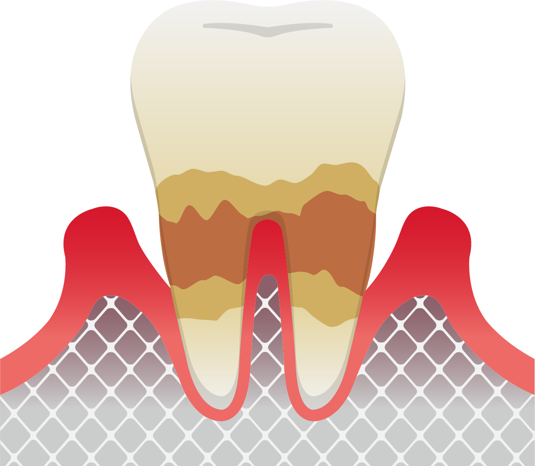 中度歯周炎
